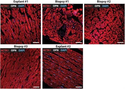 Nuclear Osteopontin Is a Marker of Advanced Heart Failure and Cardiac Allograft Vasculopathy: Evidence From Transplant and Retransplant Hearts